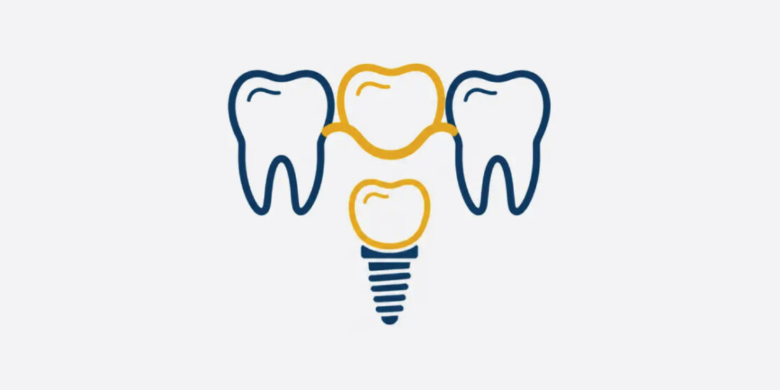 Illustration of dental bridge and implant restoration options for replacing a missing tooth.