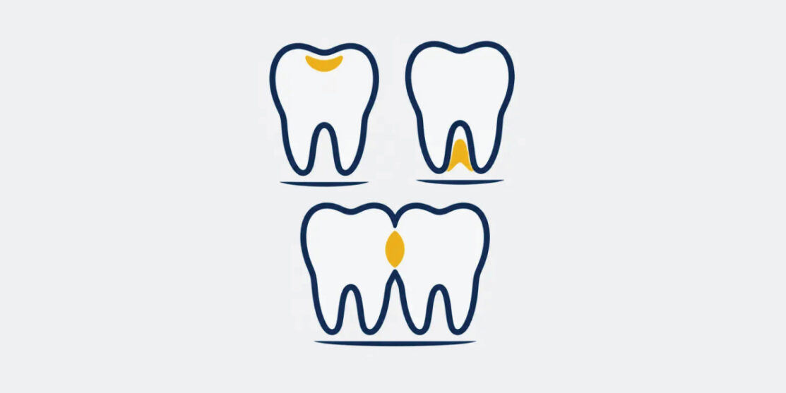 Navy and gold tooth icons representing different cavity locations on a light gray background