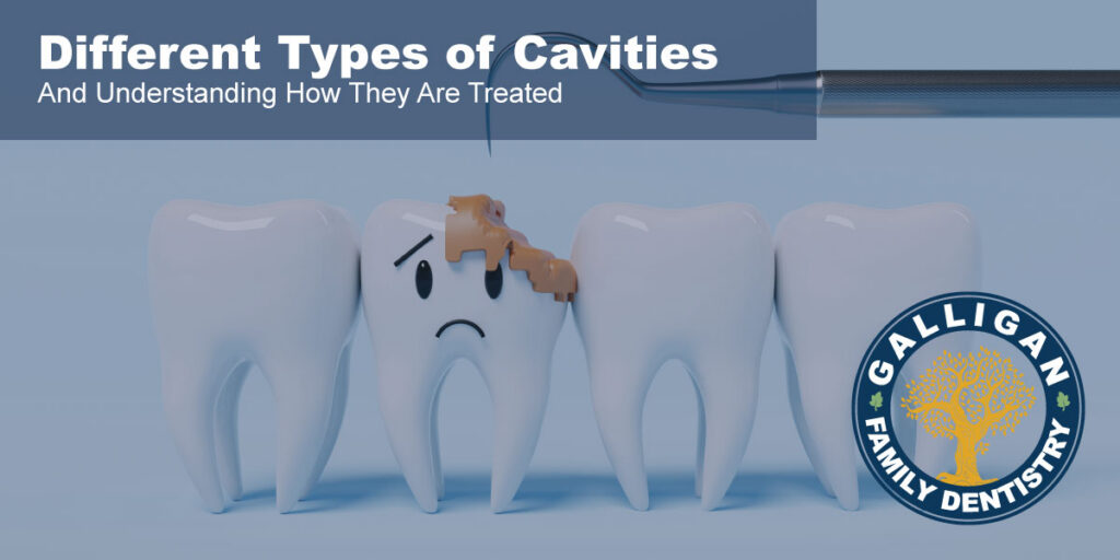 Different Cavity Types & Treatments | Galligan Family Dentistry