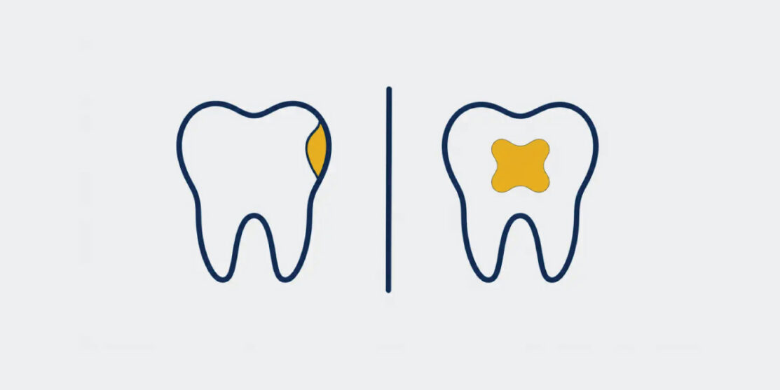 Navy and gold paired tooth icons comparing cosmetic bonding and a dental filling