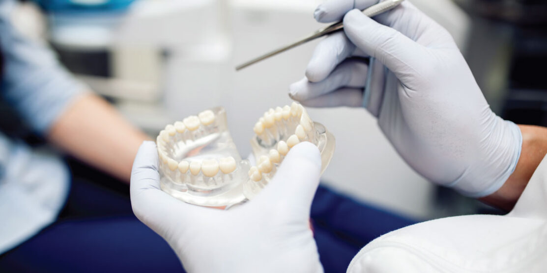 Blog Image Regarding Determining the Need for Crown over a Filling
