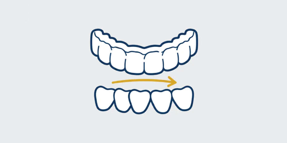 Navy and gold line icon of clear aligners, slightly uneven teeth, and an alignment arrow on a light gray background