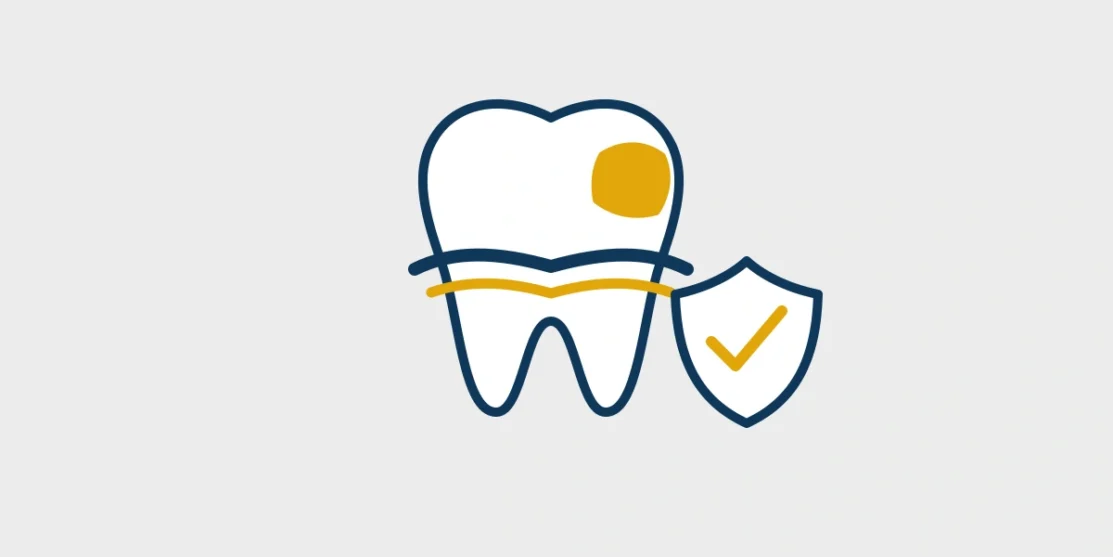 Tooth with a small tooth-colored restoration and protective checkmark shield